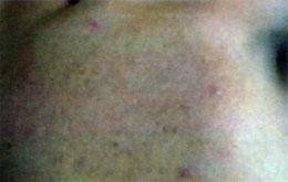 Acne Treatment After Laser Acne Treatment After