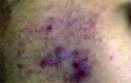 Acne Treatment Before Laser Acne Treatment Before