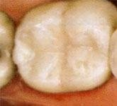 Fillings After white fillings in Catford - white Fillings After