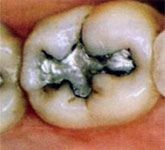 Fillings Before Fillings Before