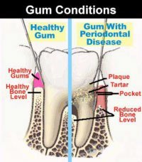 Gum Condition