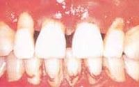 Gum Disease