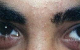 Hair Removal After Hair Removal After