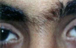 Hair Removal Before Hair Removal Before