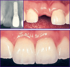 Implant