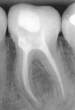 Root Canal