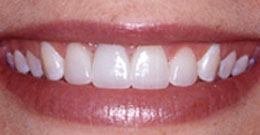 After Veneers Veneers Catford - after photo of teeth after veneers