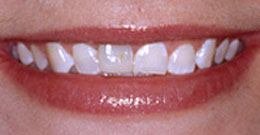 Before Veneers Veneers Catford - Before photo of teeth before veneers