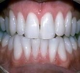 Whitening After Teeth Whitening in Catford After