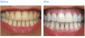tooth whitning
