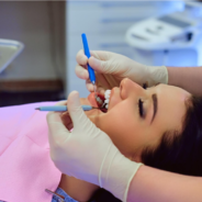 Root Canal in Lee, London: What You Need to Know and Where to Get the Best Care